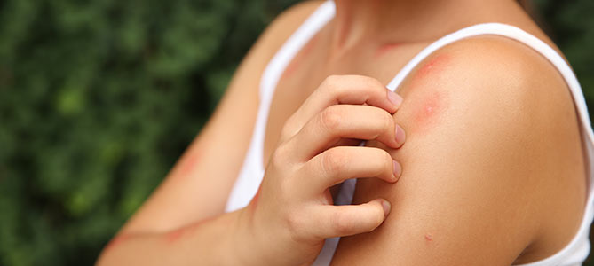 Insect Bite Treatment Specialist Near Me in Twin Falls, ID Insect Bite Treatment Specialist Near Me in Twin Falls, ID