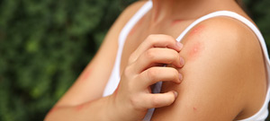 Insect Bite Treatment Specialist Near Me in Twin Falls, ID Insect Bite Treatment Specialist Near Me in Twin Falls, ID