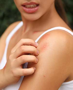 Insect Bite Treatment Specialist Near Me in Twin Falls, ID